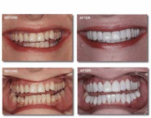 Before and After Smile Gallery