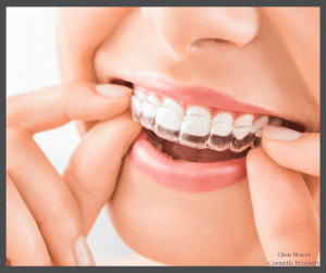 Person inserting clear aligner onto upper teeth &mdash; &ldquo;Clear Braces Cosmetic Dentistry&rdquo; watermark